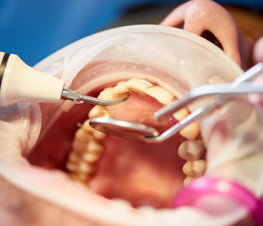 Próteses Dentárias